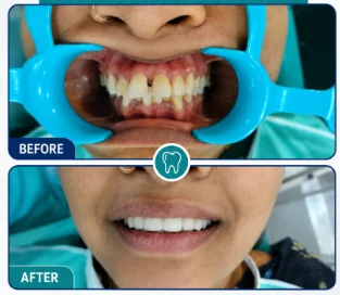 Smile Makeover Before and After
