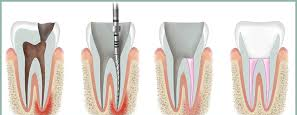 Root Canals