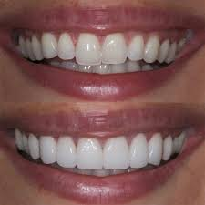 Teeth Reshaping